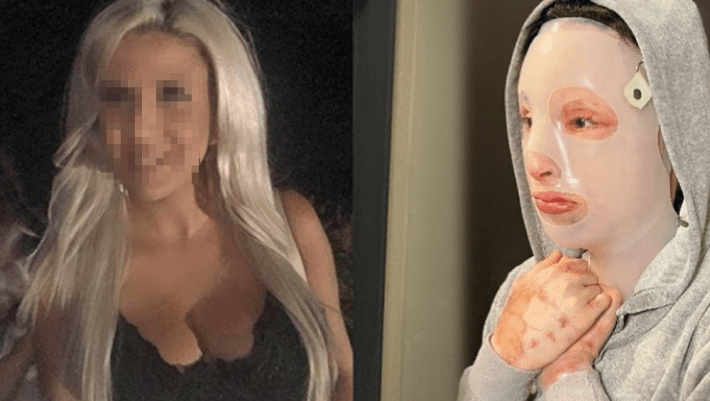 «Το αφτί της έχει εξαφανιστεί»: Συγκλονιστική η εικόνα της Ιωάννα 1 χρόνο μετά την επίθεση με βιτριόλι (Vid)