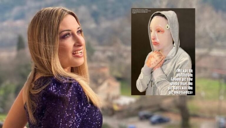 Ιωάννα Παλιοσπύρου: H πρώτη φωτογραφία του καμμένου χεριού της μετά την επίθεση με βιτριόλι (Pic & Vid)