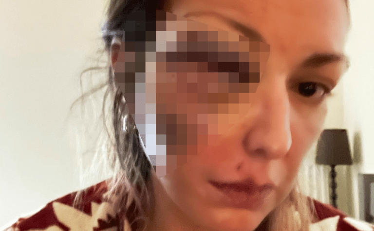 Κύμα συμπαράστασης στο Twitter για τη blogger που ξυλοκοπήθηκε βάναυσα από τον σύντροφό της (Pic)