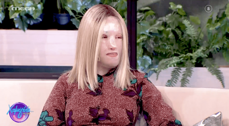 Ιωάννα Παλιοσπύρου | Η πρώτη φωτογραφία του προσώπου της δίχως τη μάσκα μετά την επίθεση με το βιτριόλι (Vid)