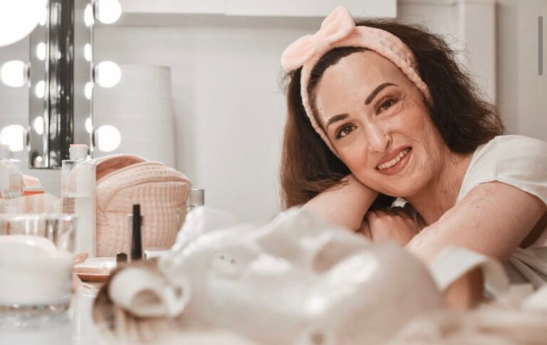 Δύναμη ψυχής: Η Ιωάννα Παλιοσπύρου δείχνει το πρόσωπό της χωρίς μακιγιάζ μετά την επίθεση με το βιτριόλι (Pics)